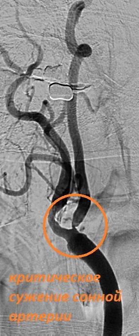 Стеноз внутренней сонной артерии