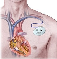 Имплантация кардиостимулятора
