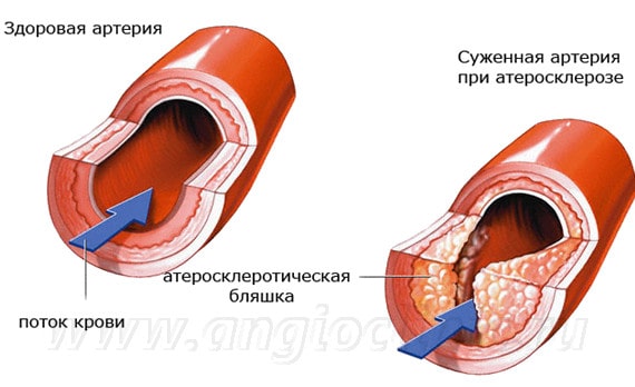 Атеросклероз - развитие бляшек в артериях